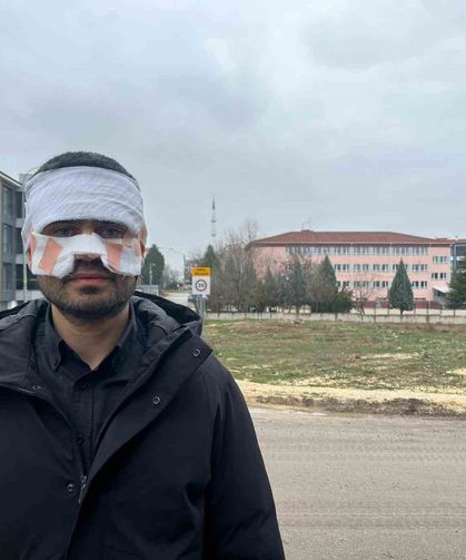 Rehber öğretmenin yüzüne sıcak çay fırlattığı fizik öğretmeni feci şekilde yandı