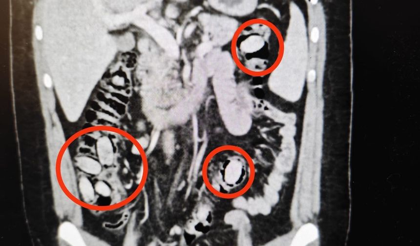 Midesinde taşıdığı uyuşturucu maddeler polisin dikkatinden sayesinde ele geçirildi